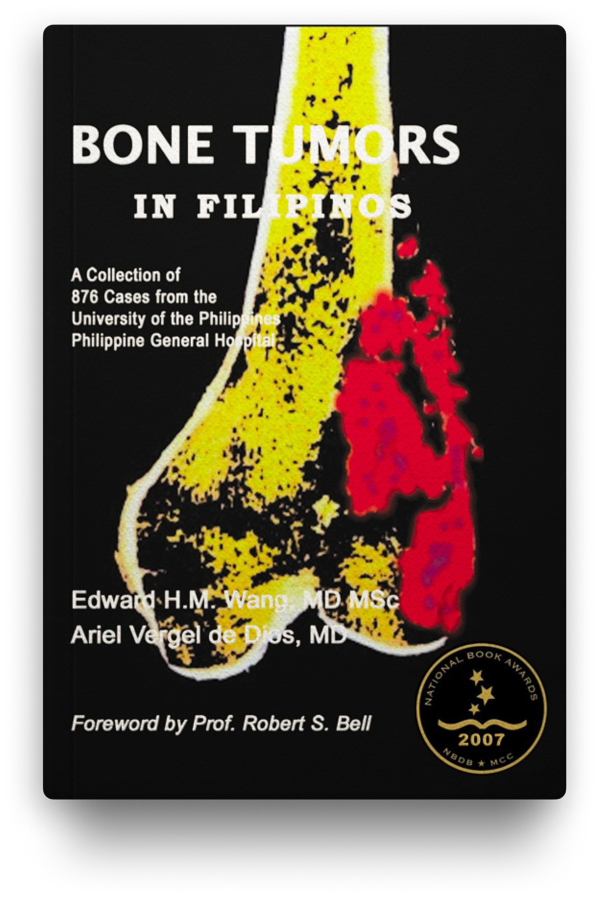 Bone Tumors In Filipinos