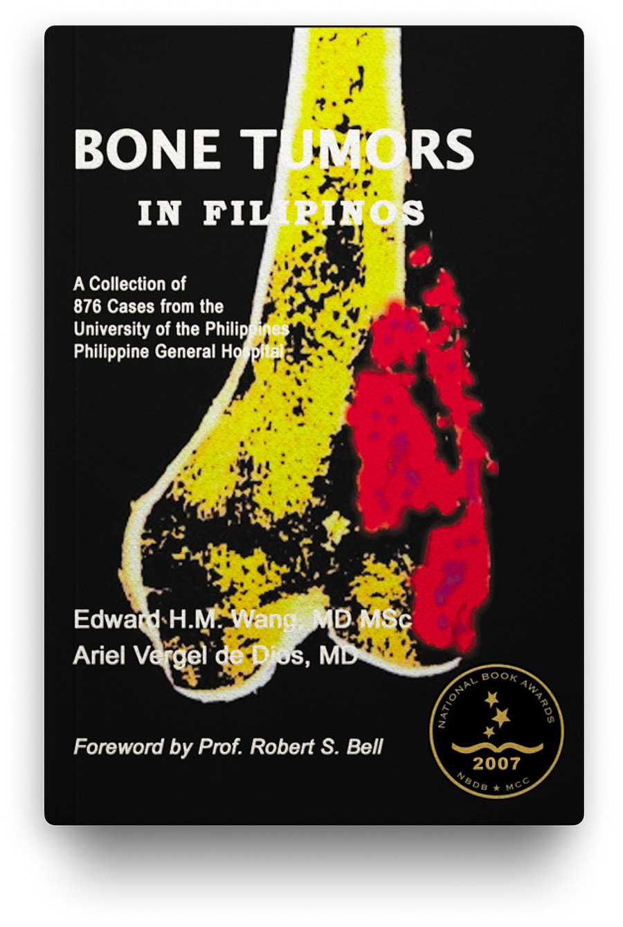 Bone Tumors In Filipinos